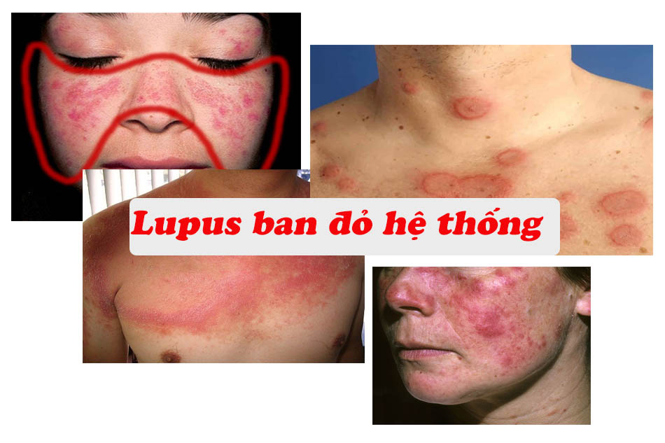 Bệnh lupus gây các tổn thương trên da.jpg